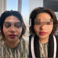 مرکزتخصصی لیفت بانخ و کانتورینگ صورت|خدمات آرایشگری و زیبایی|کرمانشاه, |دیوار