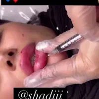 نیازمند مدل تزریق ژل|خدمات آرایشگری و زیبایی|ارومیه, |دیوار