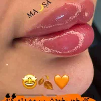 تزریق ژل و بوتاکس تضمینی