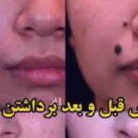 فیشال تخصصی برداشتن خال ولک ،بوتاکس،مزو تراپی،