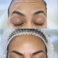 تخفیف ویژه فیلر بوتاکس prpمزو|خدمات زیبایی و سلامت|تهران, جوادیه تهرانپارس|دیوار