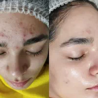 فیشیال تخصصی و خالبرداری|خدمات زیبایی و سلامت|مشهد, توس (بلوار توس)|دیوار
