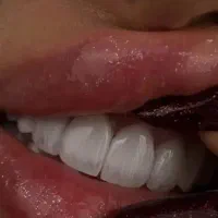 کامپوزیت دندان سارمکو کاریزما آی پی اس الترادنت|خدمات زیبایی و سلامت|تهران, نارمک جنوبی|دیوار