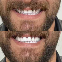 دندان مصنوعی بدون لقی