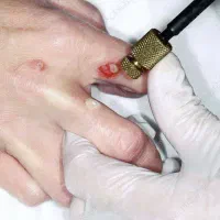 کارشناس درمان زگیل و تبخال