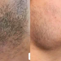 درمان ریزش مو|خدمات آرایشگری و زیبایی|مشهد, گوهرشاد|دیوار