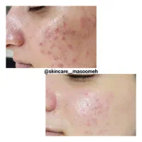 نیازمند مدل خانوم برای پاکسازی پوست|خدمات آرایشگری و زیبایی|لاهیجان, کوی خزر|دیوار