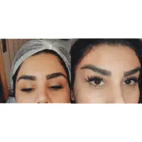 عمل لیفت ابرو وشقیقه جراحی ۸م بوتاکس مصپورت ۶۰۰|خدمات آرایشگری و زیبایی|مشهد, شهید فرامرز عباسی|دیوار