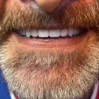 دندان مصنوعی دندان متحرک دندان سازی