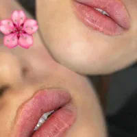 تزریق ژل وبوتاکس فوری