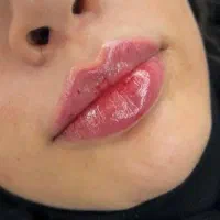 ژل بوتاکس نخ پی ارپی توسط پزشک