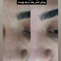 پاکسازی تخصصی صورت|خدمات آرایشگری و زیبایی|محمدشهر, محمدشهر|دیوار