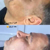 تزریق هرنوع خدمات زیبایی به صورت تضمینی|خدمات آرایشگری و زیبایی|کارون, |دیوار