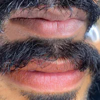 فراخوان درمان تیرگی لب