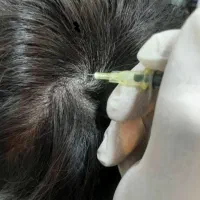 جشنواره prp و مزوتراپی ( آقایان و بانوان)|خدمات آرایشگری و زیبایی|بروجرد, |دیوار