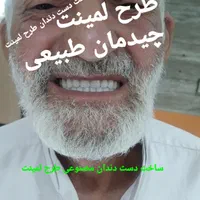 ‌دندان ژله‌ای آلمانی طرح لمینت دست دندان کامپوزیتی|خدمات آرایشگری و زیبایی|کرج, مصباح|دیوار