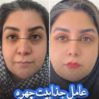 کلینیک زیبایی و جراحی بلفاروپلاستی و بینی|خدمات آرایشگری و زیبایی|فردیس, طالقانی|دیوار