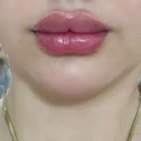ژل بوتاکس لیفت نخ پی ارپی لیزر پیکرتراشی بلفارو