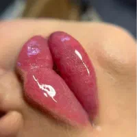 آفر ژل و بوتاکس