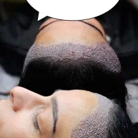 کاشت مو فقط در یک روز با ضمانت تراکم|خدمات آرایشگری و زیبایی|اصفهان, کشاورزی|دیوار