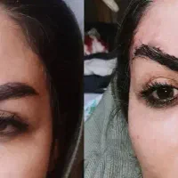 عمل لیفت ابرو و شقیقه جراحی ۸.بوتاکس مصپورت ۶۰۰|خدمات آرایشگری و زیبایی|مشهد, شهید فرامرز عباسی|دیوار