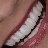 کامپوزیت دندان فقط قیمت مواد فرصت طلایی