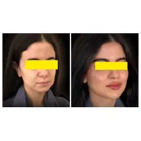 ژل بوتاکس پی ار پی توسط پزشک|خدمات آرایشگری و زیبایی|شاهین‌شهر, فردوسی|دیوار