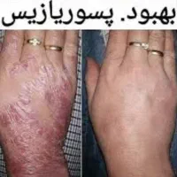 کرم درمان پسوریازیس و اگزما|آرایشی، بهداشتی، درمانی|تهران, حسین‌آباد|دیوار
