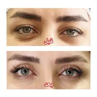 تخفیف ۵۰ درصدی بلفاروپلاستی دکتر غلامرضا امامی