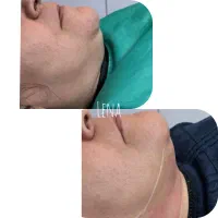 خدمات هایفو لیفت ورفع غبغب