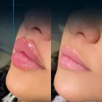 تزریق فیلر یک سی سی 890