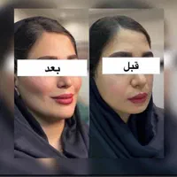 پکیج طلایی نقره ایی برنز لیفت با فیلر ژل بوتاکس|خدمات آرایشگری و زیبایی|مشهد, سناباد|دیوار