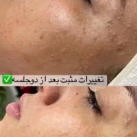 تخفیف ۵۰ ٪فیشیال ( بانوان) آنوبیس  اکلادو  هرموس|خدمات آرایشگری و زیبایی|مشهد, سجاد شهر|دیوار