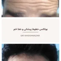 تخفیف ویژه بوتاکس فیلر و جوانسازی|خدمات آرایشگری و زیبایی|ورامین, خیر آباد|دیوار