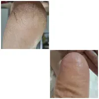 پدیکور درمانی آقایان در کلینیک پوست دریک‌جلسه|خدمات آرایشگری و زیبایی|پردیس, فاز ۲|دیوار