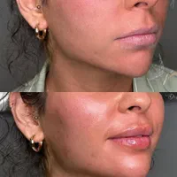 مدل ژل و بوتاکس|خدمات آرایشگری و زیبایی|شیراز, ملاصدرا|دیوار