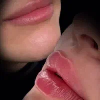 تخفیف ۴۰ درصدی ژل وبوتاکس توسط پزشک