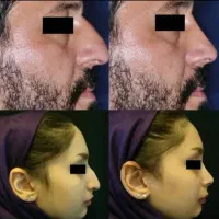 عمل جراحی بینی وترمیم باپیزو/لیفت صورت وپلک|خدمات آرایشگری و زیبایی|کرج, چهارصد دستگاه|دیوار
