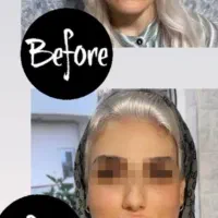 ساکش غبغب تزریق .باسن.شکم|خدمات آرایشگری و زیبایی|کرمانشاه, |دیوار