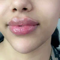 خدمات ژل ،بوتاکس،نخ