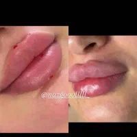 خدمات ژل و بوتاکس|خدمات آرایشگری و زیبایی|بهبهان, |دیوار