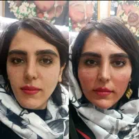 تزریق ژل بوتاکس و ساکشن تزریق چربی درکلینیک|خدمات آرایشگری و زیبایی|کرمانشاه, |دیوار