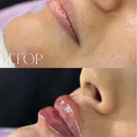 تخصص در بوتاکس و فیلر و جوانسازی|خدمات آرایشگری و زیبایی|شیراز, بعثت|دیوار