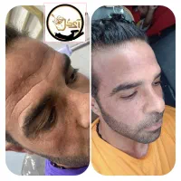 تزریق ژل،بوتاکس،آنزیم،پی آر پی، مزو ژل برای آقایان|خدمات آرایشگری و زیبایی|خرمشهر, |دیوار