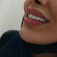 روکش زیرکونیا و پی اف ام با قیمتی باور نکردنی