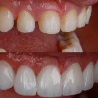 دندانپزشکی عصب کشی 3 میلیون،کامپوزیت فکی ده میلیون