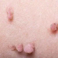 رفع دائمی زگیل و تبخال