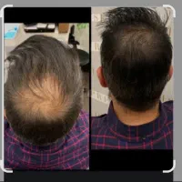 میکرواسکالپ