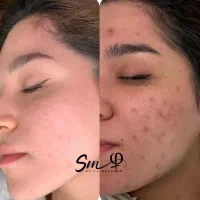 کربن تراپی (روشن سازی پوست کل بدن)