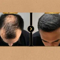 ریزش مو داری راه حلش اینجاس